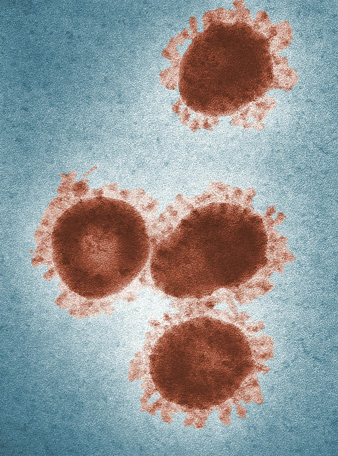 Chronic Inflammatory Response Syndrome (CIRS): A Functional Medicine Approach to Diagnosis and Treatment