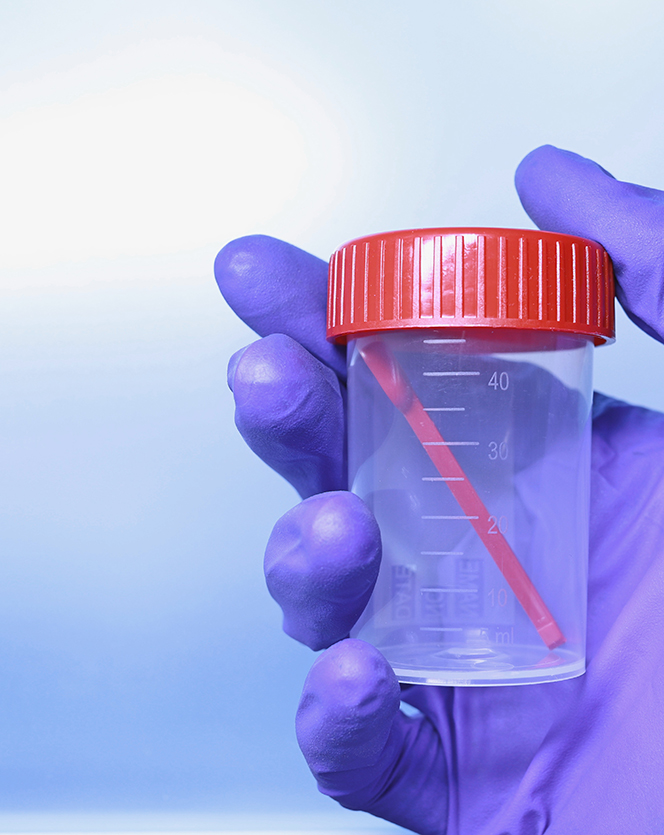 Biomaterial container with milliliter scale in doctors hand. Closed transparent sterile medical container for stool and urine analysis. Collecting analysis. Diarrhea, intestines disease